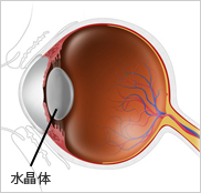 白内障眼球イメージ