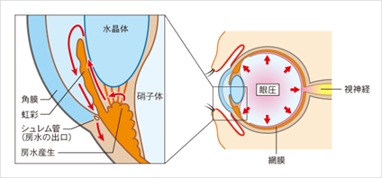 緑内障イメージ