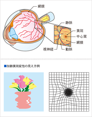 加齢黄斑変性イメージ