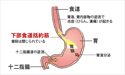 逆流性食道炎イメージ