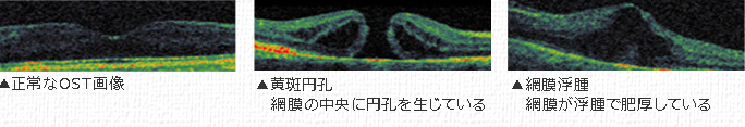 OCT検査イメージ写真